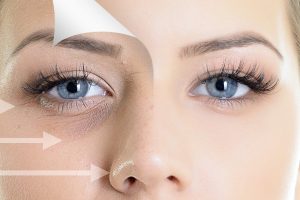 Reducing Under Eye Swelling After Fat Injection